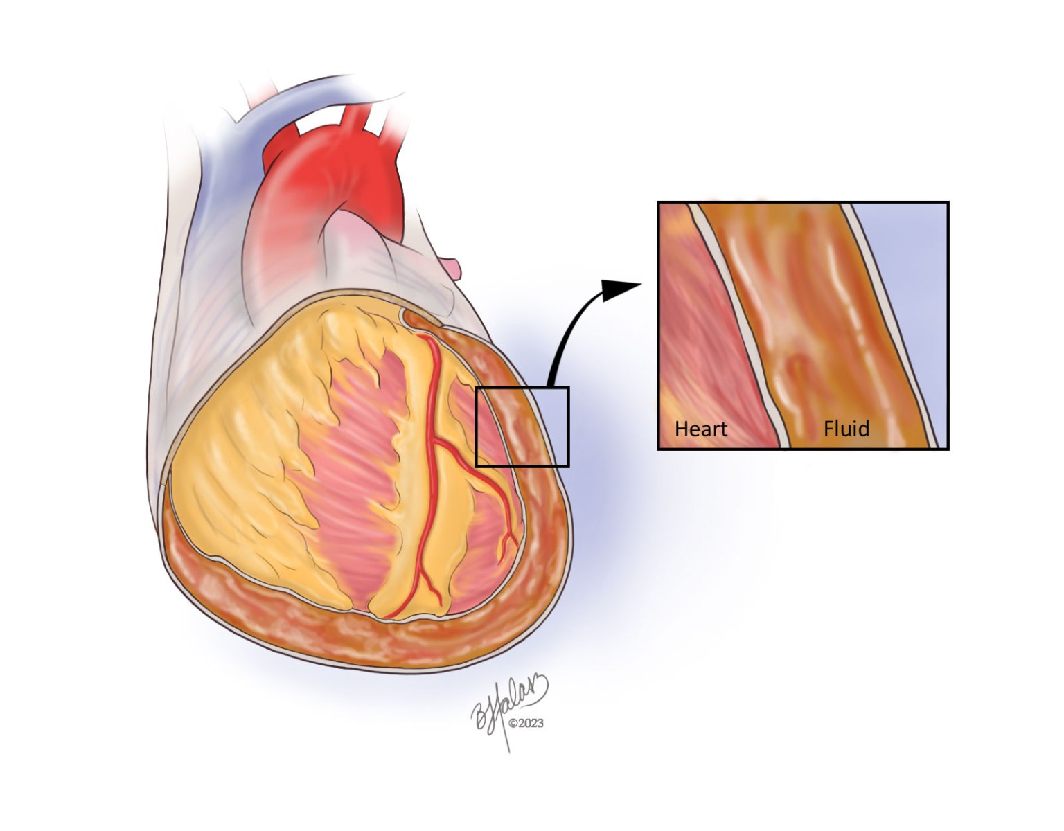 heart with pericardial effusion